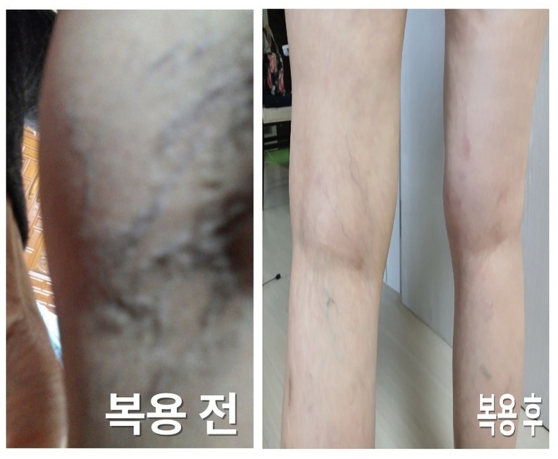 하지정맥 환자-(비포 애프터 사진)-BOX337 제공
