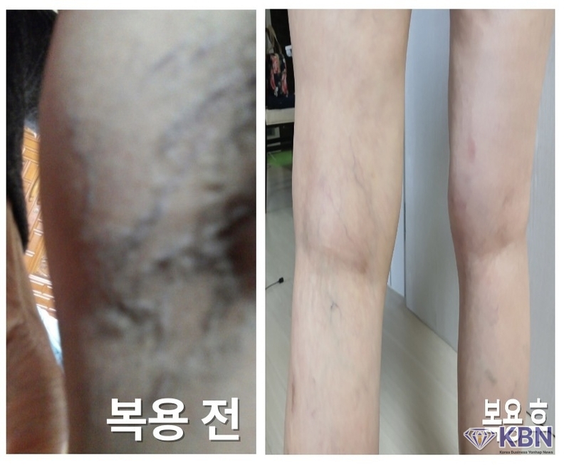 영조와 어머나 식품을 통해 변환된 하지정맥 환자-사진 BOX 337, 중고왕 제공